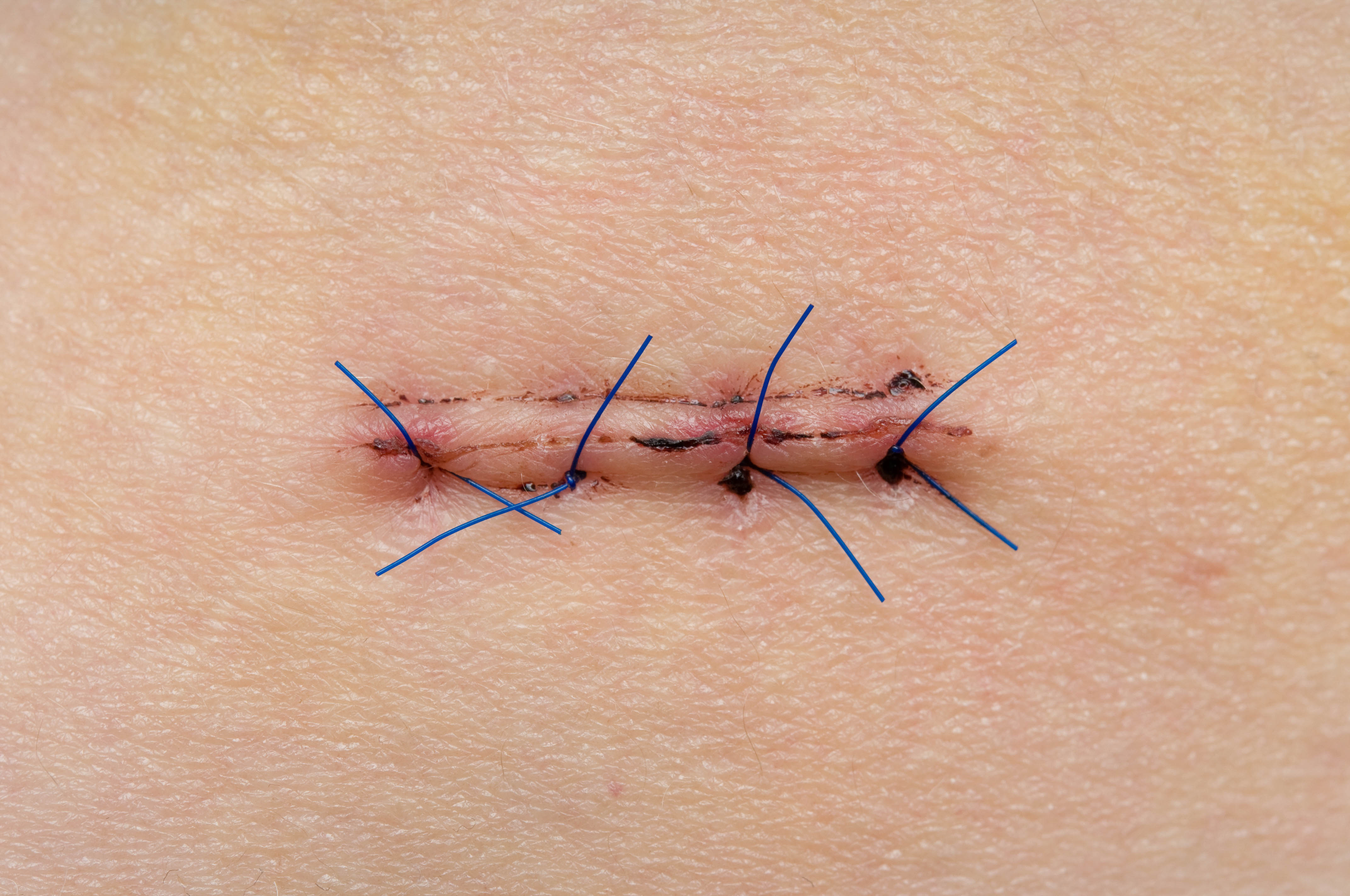 The-history-of-the-suture-option2