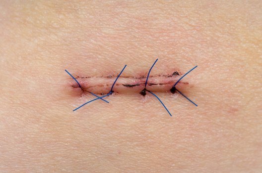 The-history-of-the-suture-option2